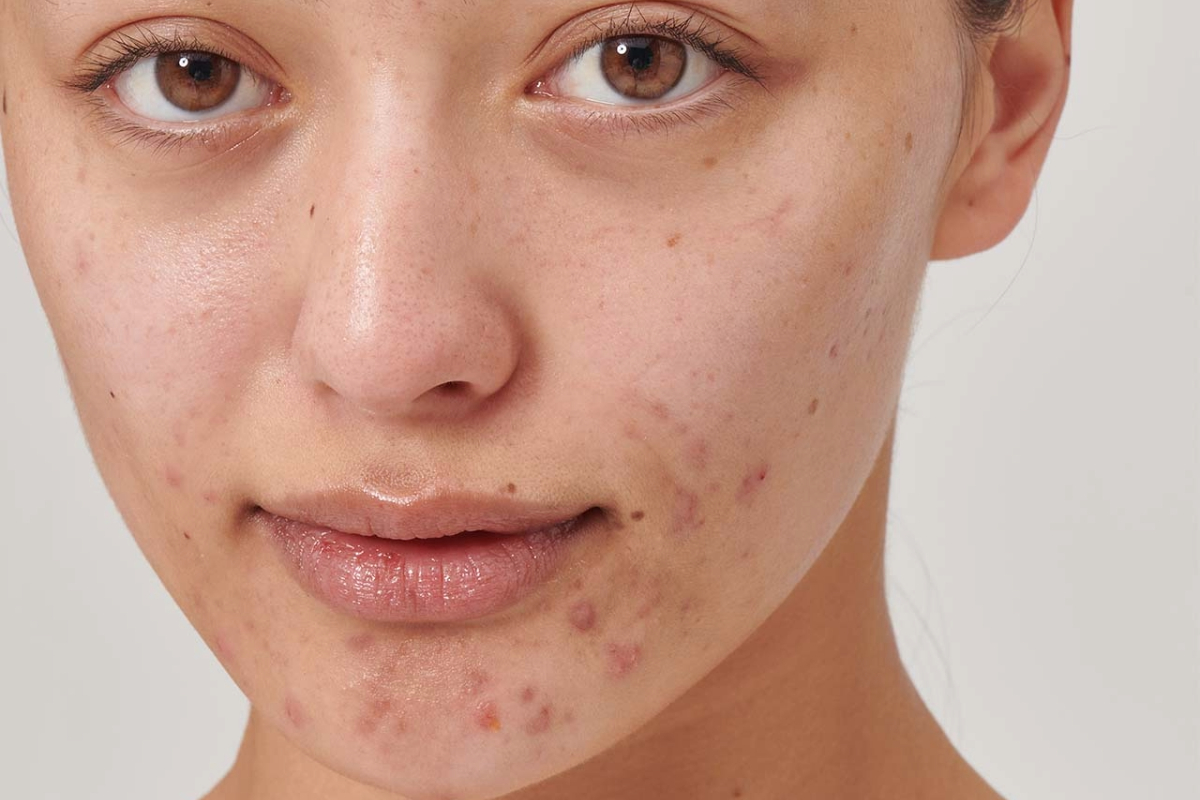 Fatigue & Low Energy Affecting Skin